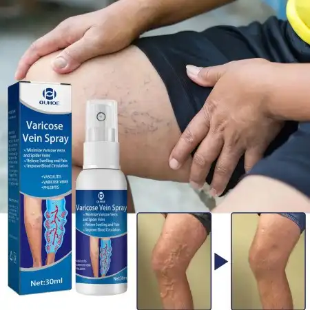 Varicose Veins Spayer